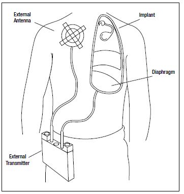 圖7，呼吸起搏器帶有用于膈神經刺激的植入電極以及RF接收器，還有向植入體發射RF信號的外部天線，完成刺激起搏功能