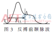 qrs2-t3.gif